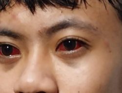 Bahaya Gas Air Mata, Dosen FK UM Surabaya: Bisa Sebabkan Pendarahan dan Erosi Kornea